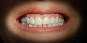 Gencive blanche : un signe d-anemie ?