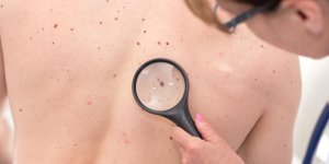 Carcinome basocellulaire : les differentes formes