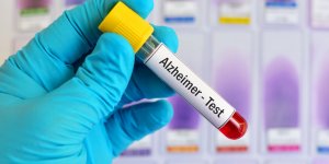 Alzheimer : ce test peut detecter la maladie 17 ans plus tot