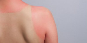 Coups de soleil : quand faut-il consulter ?