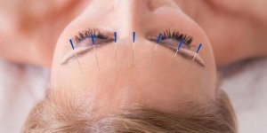 Urticaire et grossesse : l-acupuncture comme traitement naturel