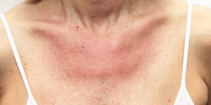 Allergie au soleil : 5 gestes pour la soulager 