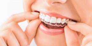Ces kits pour blanchir les dents favorisent leur erosion