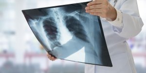 Cancer du poumon : pres de 5 ans de vie en plus grace au depistage precoce