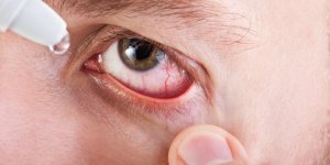 Œil irrite : une secheresse oculaire en cause