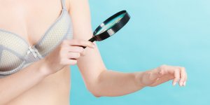 Melanome : plus de risques d’en mourir apres le deces du conjoint
