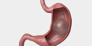 “En 4 mois, j-ai perdu 26 kilos grace a un ballon gastrique”