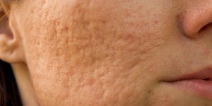 Peau granuleuse : un signe d-allergie au visage ?