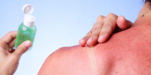 8 choses a ne pas mettre sur un coup de soleil