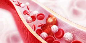 Phlebite : 7 exercices faciles pour l-eviter