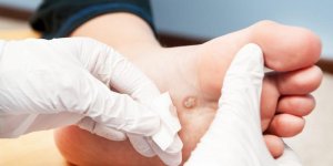 Verrue seborrheique : testez l-acupuncture