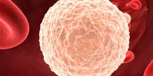Sueurs nocturnes abondantes : un signe de lymphome ?