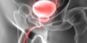 Troubles de l-erection : un signe d-adenome de la prostate ?