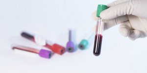 Traitement a l-atorvastatine : la frequence a laquelle faire des bilans lipidiques