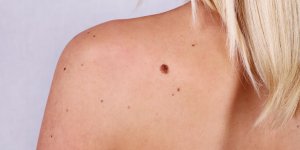 Melanome metastatique : quels symptomes ? 