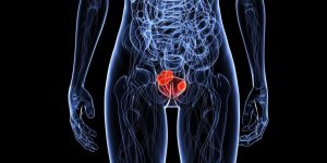 Cancer de la vessie : polype ou tumeur, une difference ?