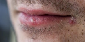 Comment soigner le bouton de fievre ?