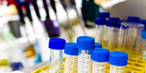 Tuberculose urinaire : quand faire un ECBU ?