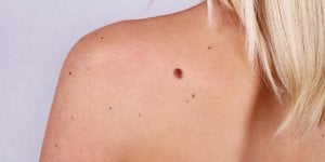 Carcinome malpighien : l-esperance de vie