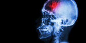 AVC silencieux : les signes qui doivent alerter