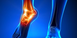 Mal sous les pieds : un signe d-arthrose ?