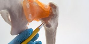 Fracture du femur : le traitement par clou gamma