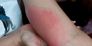 Desorientee, elle pensait avoir la maladie de Lyme : la realite etait tout autre