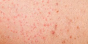 Ces petits boutons sur votre peau sont peut-etre le signe d’une keratose pilaire