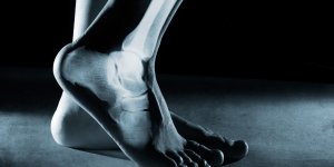 L-aptitude a marcher 1 km, un indice sur le risque de fracture