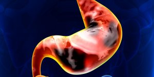 Inflammation de l-estomac : les maladies possibles