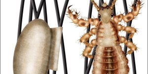 Poux : 4 manieres simples pour les eviter 