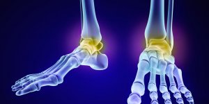 Crise de goutte : les articulations les plus touchees