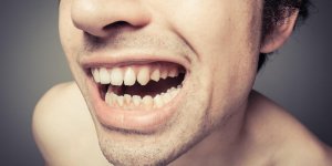 Comment enlever le tartre sur les dents