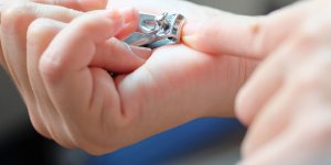 Ongles : comment reconnaitre un melanome sous-ungueal ?