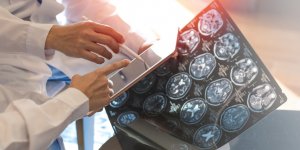 Sclerose en plaques (SEP) : une etude revele qu’une grande majorite de malades consultent des annees avant le diagnostic pour ces deux problemes
