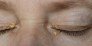 Xanthelasma : un signe predictif de maladie cardiaque