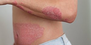 Comment soigner le psoriasis ? Temoignage d’un patient