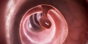 Intestin : la difference entre un polype sessile et pedicule