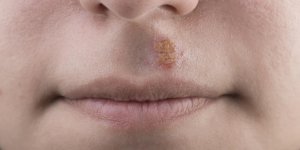 Bouton de fievre : le soigner avec de l-homeopathie