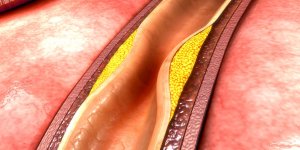 Trop de cholesterol : des symptomes cardiovasculaires ?