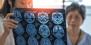 Ces medicaments pour le cœur protegent de la demence selon une etude suedoise 