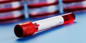 Alzheimer : un test sanguin pourrait le detecter 20 ans avant qu-il se declare 