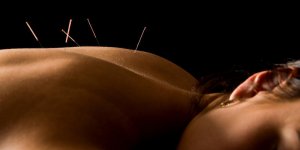 Sciatique : l-acupuncture efficace ?
