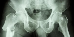 Fracture de la diaphyse femorale : un traitement