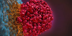 Cancer primitif du poumon : un risque de metastase dans le foie