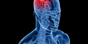Cancer du cerveau : les principaux facteurs de risque
