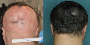 Calvitie : Un traitement fait repousser les cheveux en cinq mois