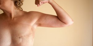 Cancer du sein : elle subit une ablation mammaire apres une erreur de diagnostic