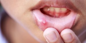 Comment soigner les aphtes chez l-enfant ?