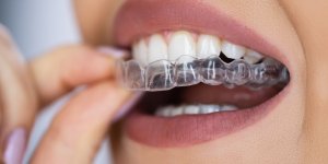 Eclaircissement dentaire : ce qu’il faut savoir sur ce "lifting des dents"